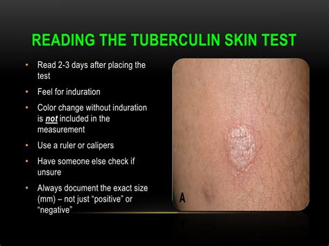 scratch tb test area|tb skin test for what.